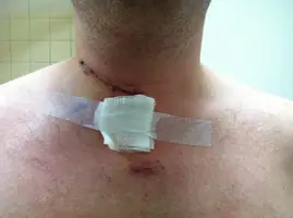 After Surgery.webp